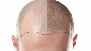 ¿Tengo que raparme para hacerme la micropigmentación capilar?