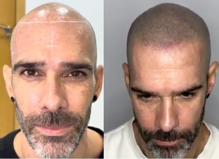 Antes y después de una micropigmentación capilar en Murcia