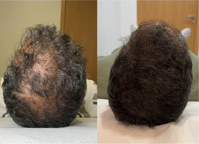 Antes y después de micropigmentación capilar en Murcia · densidad