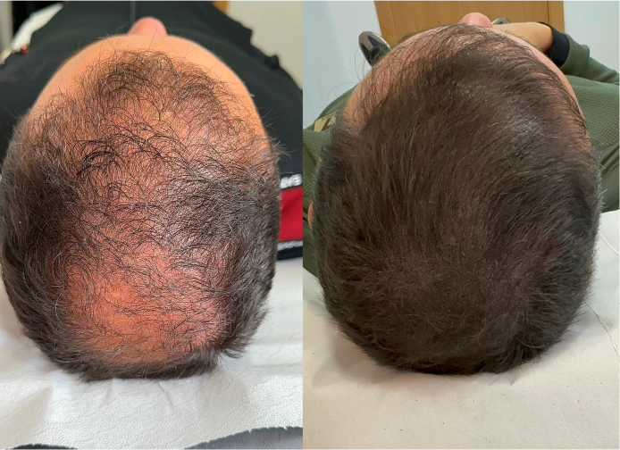 Antes y después de micropigmentación capilar en Murcia · densidad