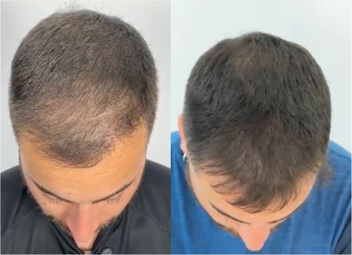 Antes y después de micropigmentación capilar en Murcia · densidad