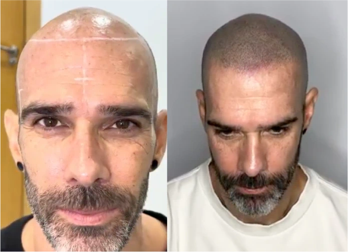 Antes y después de micropigmentación capilar en Murcia · look rapado
