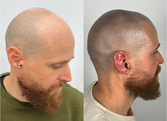Antes y después de micropigmentación capilar en Murcia · look rapado