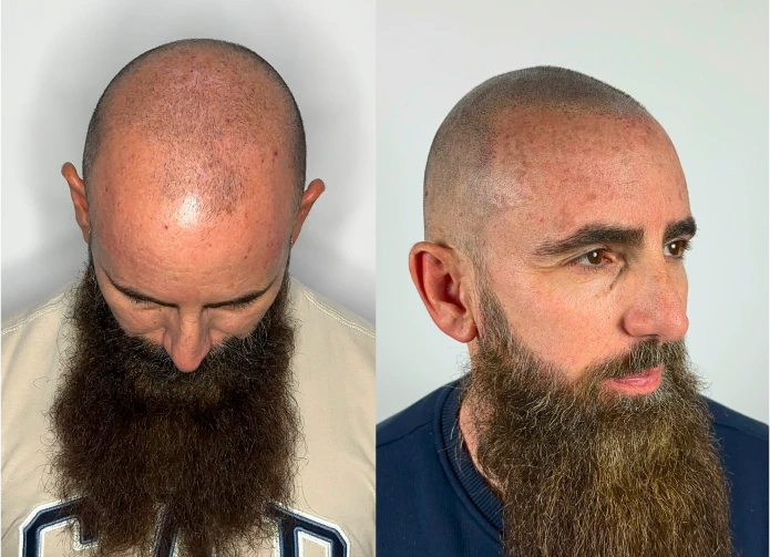 Antes y después de micropigmentación capilar en Murcia · look rapado