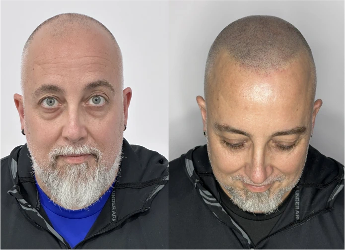 Antes y después de micropigmentación capilar en Murcia · look rapado
