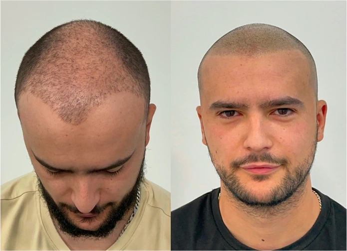 Antes y después de micropigmentación capilar en Murcia · look rapado